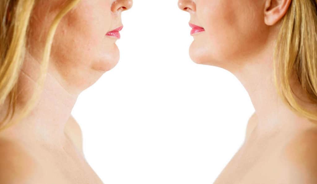 Double Chin treatment Blackwall before and after results