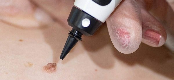 After Skin Tag Removal Blackwall