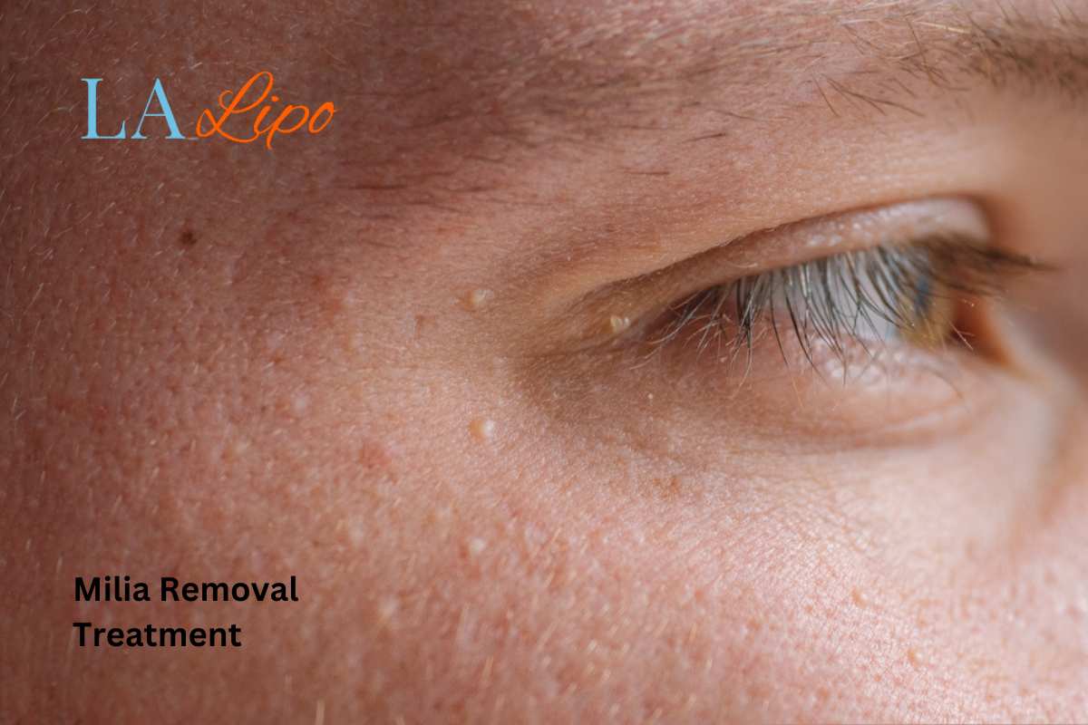 Cryopen Milia Removal: Is It the Easiest and Safest Option Blackwall?