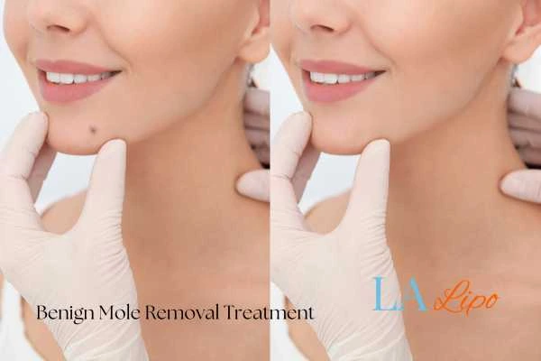 Before-and-after results following benign mole-removal treatment Blackwall