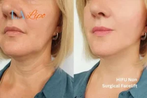 hi-fu for wrinkles Blackwall before and after results