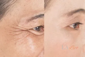 Before and after results of woman - HI-fu wrinkles reduction treatment Blackwall