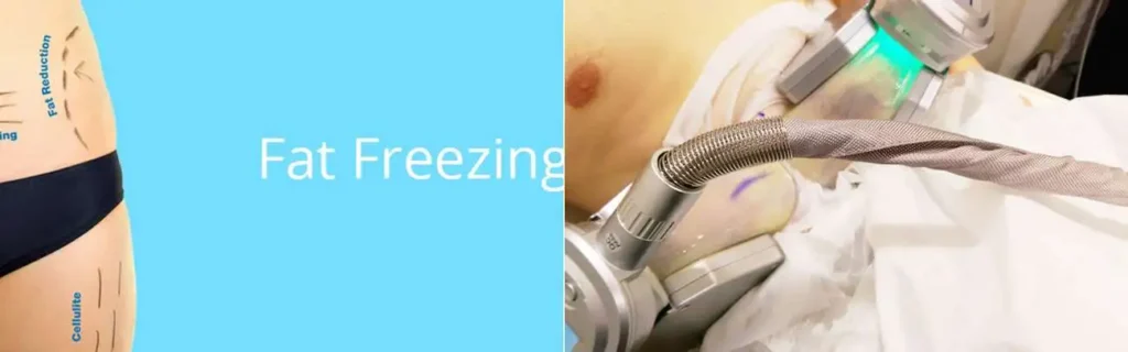 Fat freezing Blackwall on multiple areas of the body