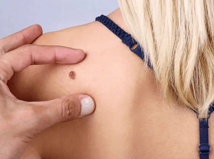 woman having mole removal Blackwall consultation before treatment.
