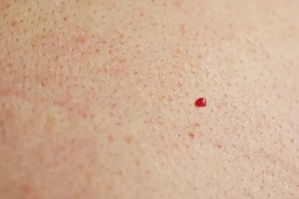 close up of a cherry angioma Blackwall
