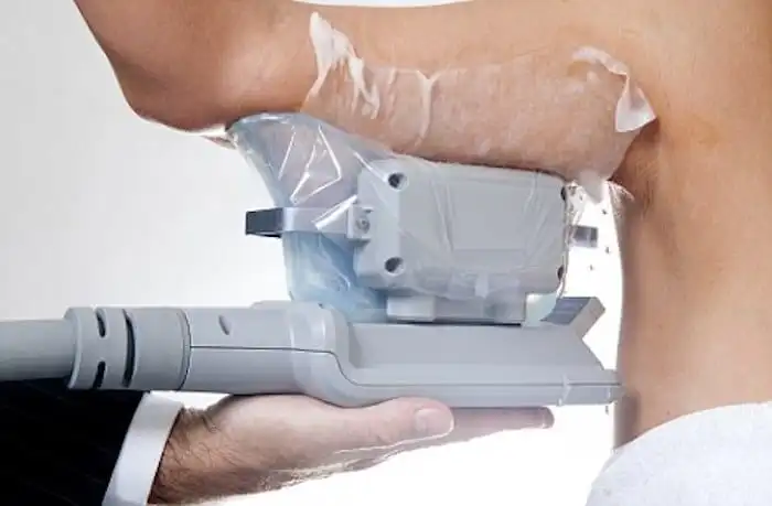 Picture of fat freezing Blackwall on the upper arms.