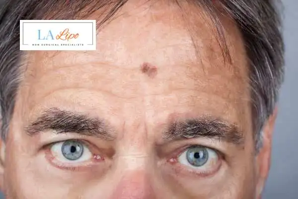 Solar Lentigo Removal Blackwall image of man with mark on his forehead