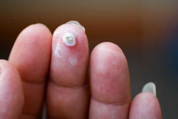 wart on person finger - cryotherapy to treat from LA LIPO Blackwall