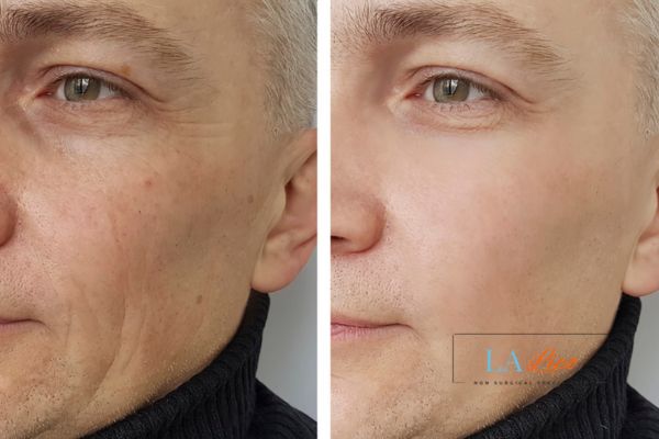 See the amazing results of Morpheus8 Treatment Blackwall!
