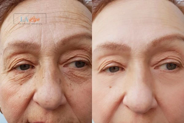 The powerful benefits of Morpheus8 Treatment Blackwall - Call Our team today!