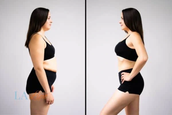 Picture of womans before and after using LA-EMS body sculpting to improve her core strength Blackwall