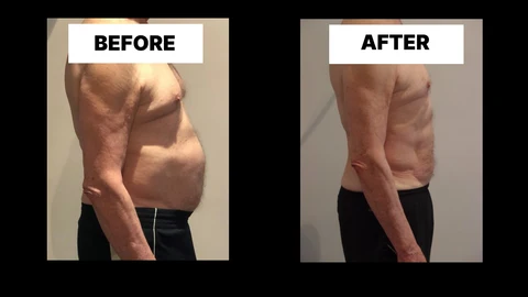 What Symptoms Can Diastasis Recti Cause in Men? Weak Core, Back Pain and Poor Posture Blackwall